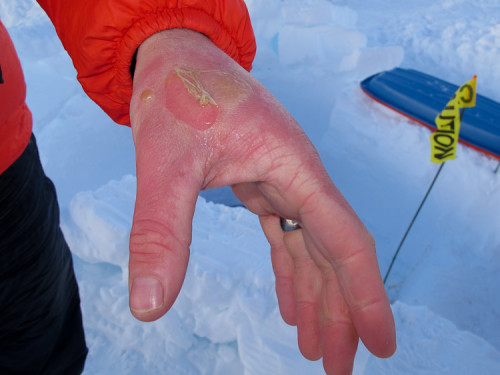 Yuck! Garrett Grove simultainiously spilled boiling water and white gas on his hand. The result wasn't pretty, but at least it was painful.